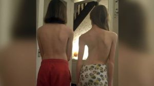 Posterior comparison of a normal spine (left) and a scoliotic spine (right)