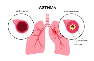 asthma