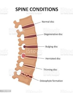 spinal conditions chiropractors handle - BBL