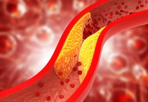 fat clogged arteries, restricting blood flow - BBL